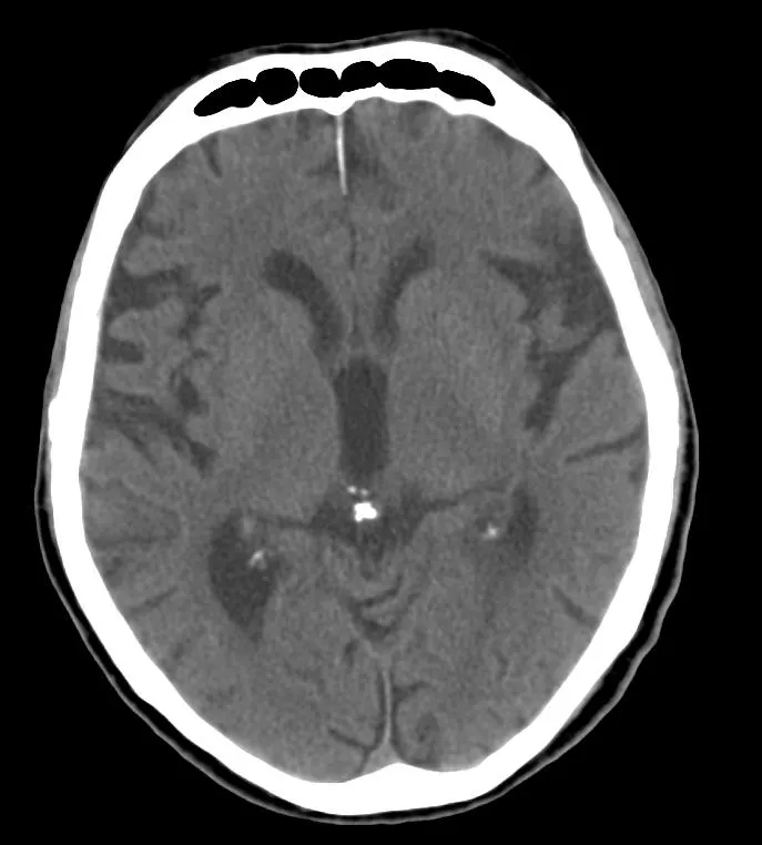 calcificazione della ghiandola pineale